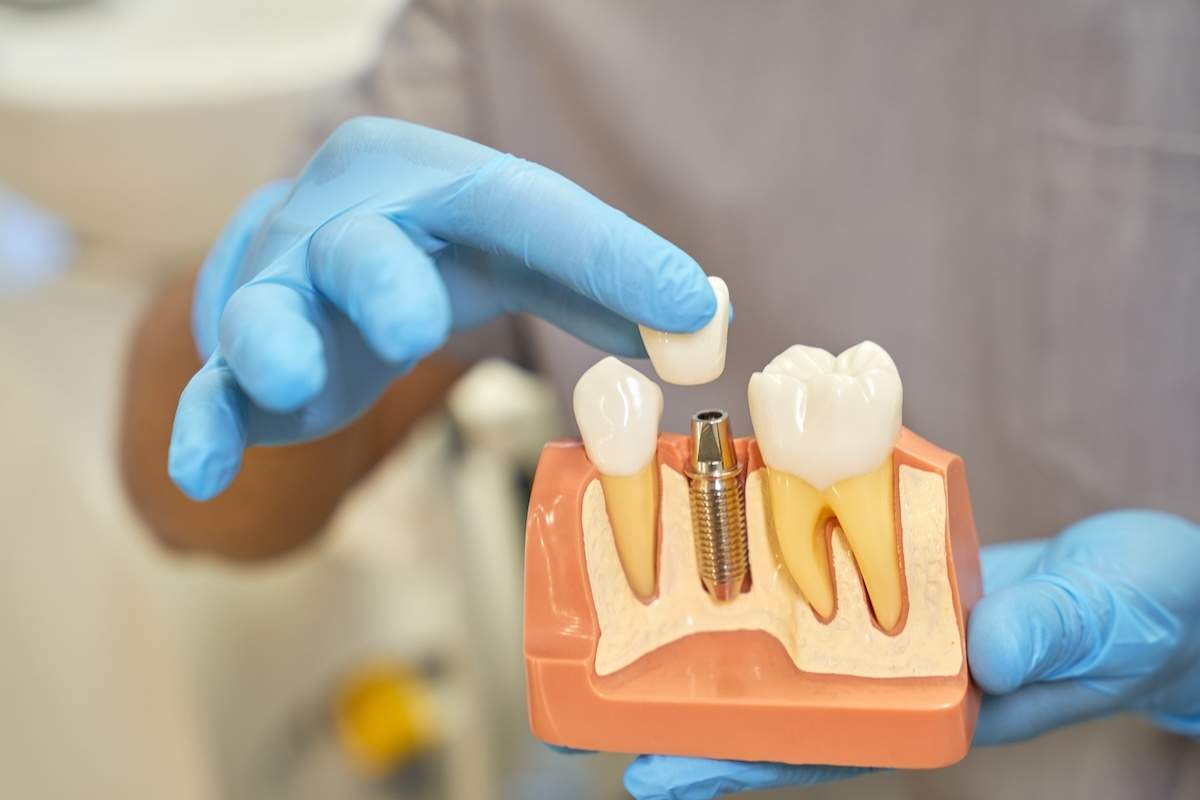 plastic-prop-of-teeth-implant-being-shown-by-denti-2023-11-27-05-09-29-utc (1)